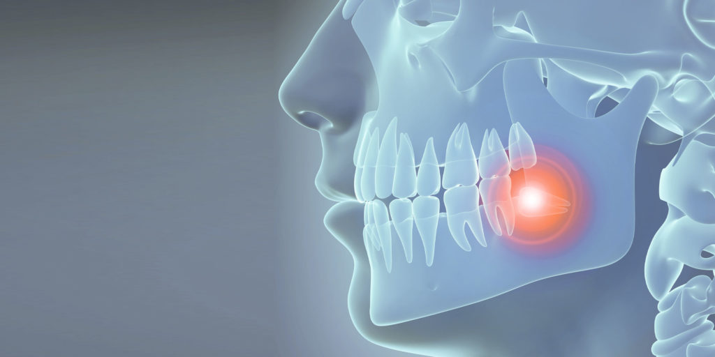 impacted wisdom teeth graphic