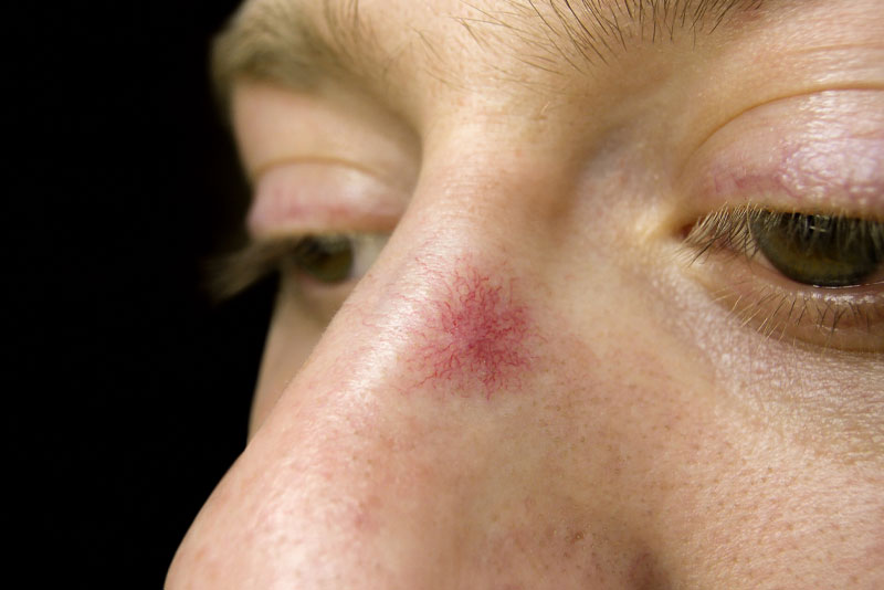 patient suffering from vascular lesions
