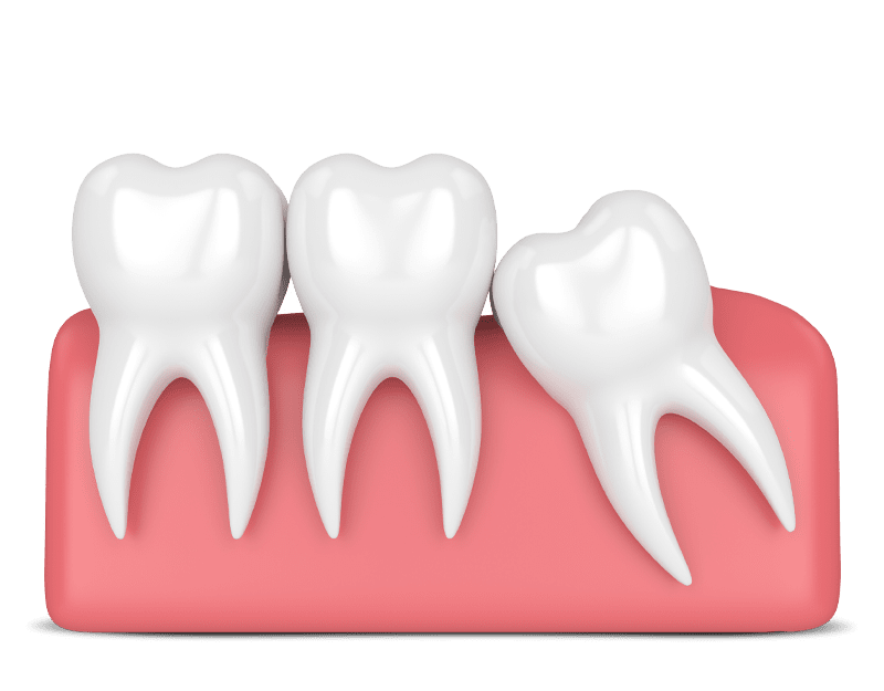 soft tissue impacted wisdom teeth graphic